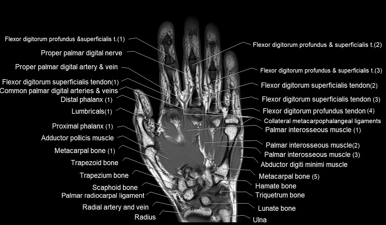 MRI 3T coronal hand cross sectional anatomy image 9.webp